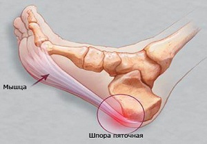 лечение пяточной шпоры в домашних условиях