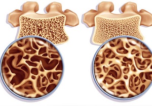 остеопения лечение