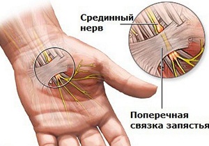 туннельный синдром лечение