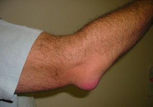 шишка на локте