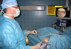 артроскопия мениска