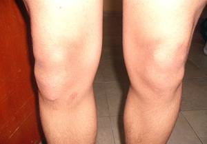 болезнь шляттера у подростков