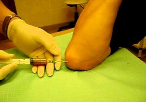 на локте появилась мягкая шишка фото