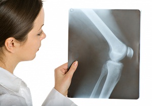 болезнь кенига рассекающий остеохондрит