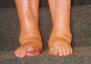 боль в тазобедренном суставе отдающая в ногу