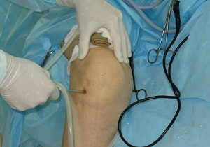 артроскопия цена