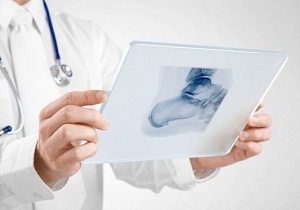 лечение пяточной шпоры рентгенотерапией