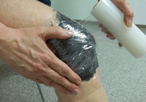 остеоартроз коленного сустава 2 степени лечение