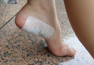 пяточная шпора фото