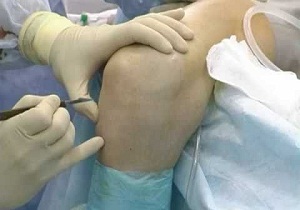 хондромаляция