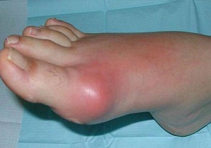 болит сустав большого пальца на ноге