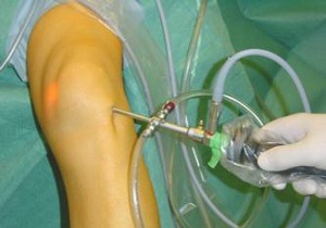 артроскопия коленного сустава отзывы