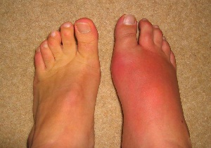 боли суставах больших пальцев ног