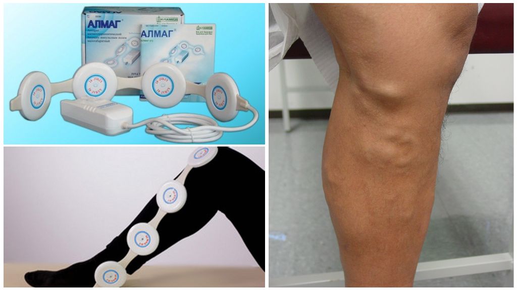 Алмаг для вен