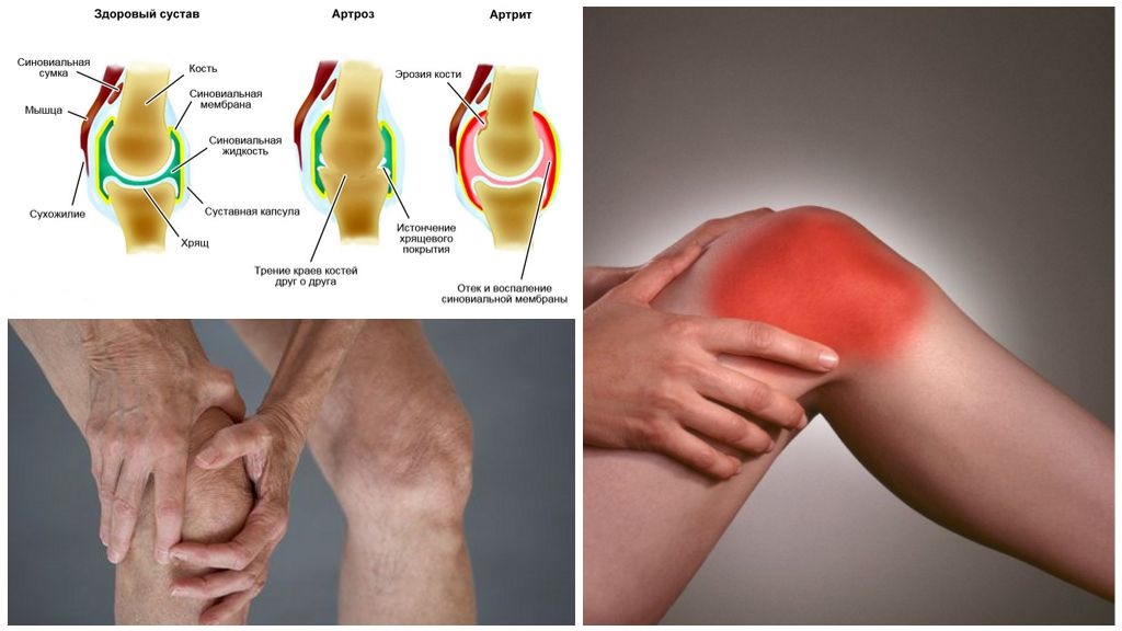 Артроз и артрит сустава
