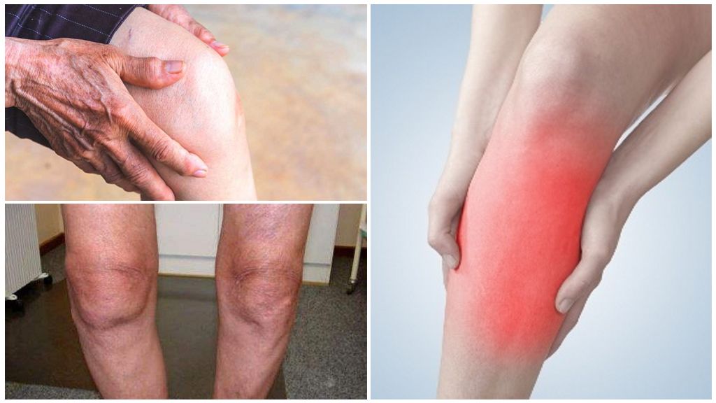 Гонартроз коленного сустава