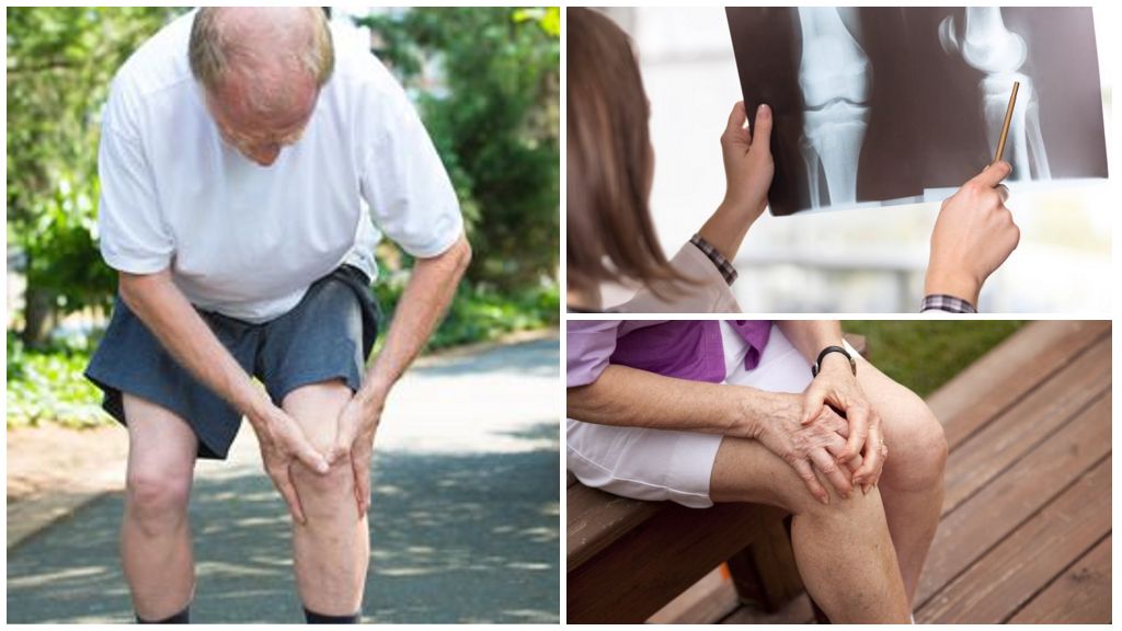 Гонартроз коленного сустава