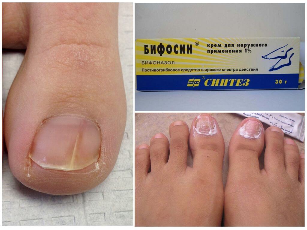 Противогрибковое средство Бифосин