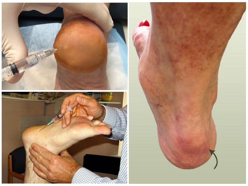 Блокада при пяточной шпоре