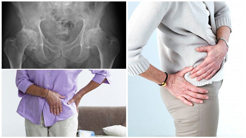 Деформирующий артроз тазобедренного сустава
