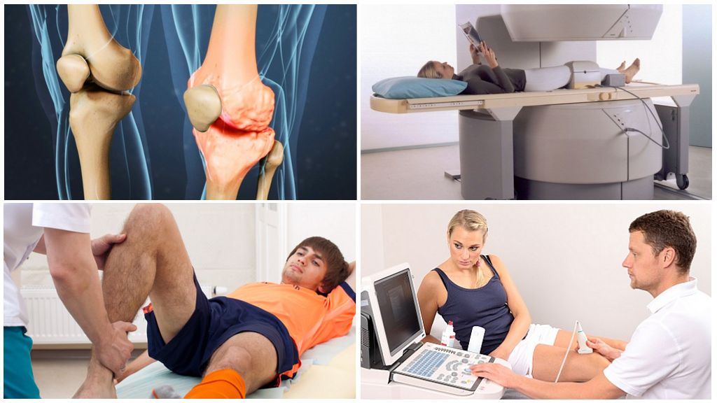 Диагностика артроза коленей