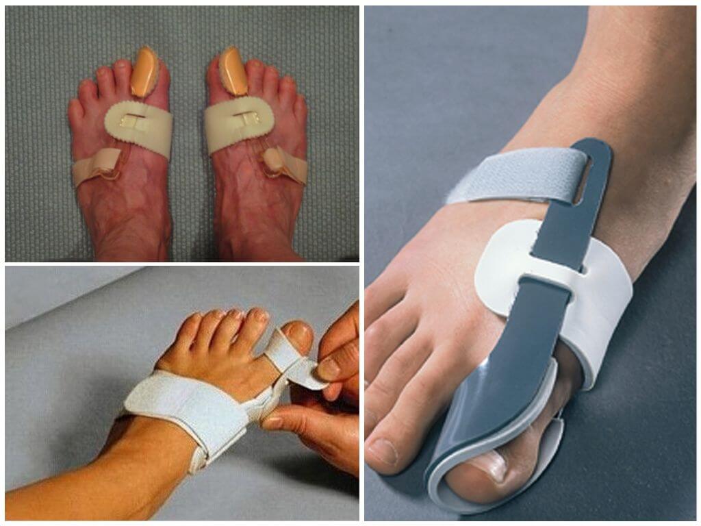 Корректоры для косточки на ноге большого пальца