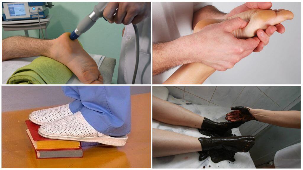 Лечение шпоры на пятках