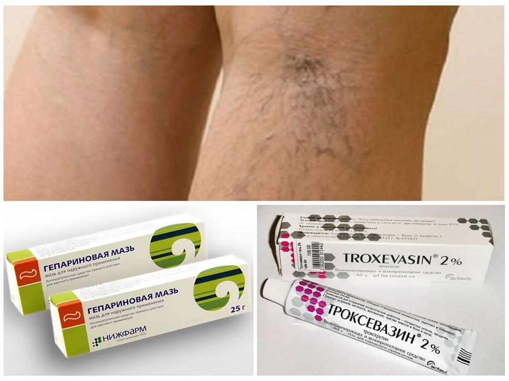 Мази для лечения варикозного расширения вен