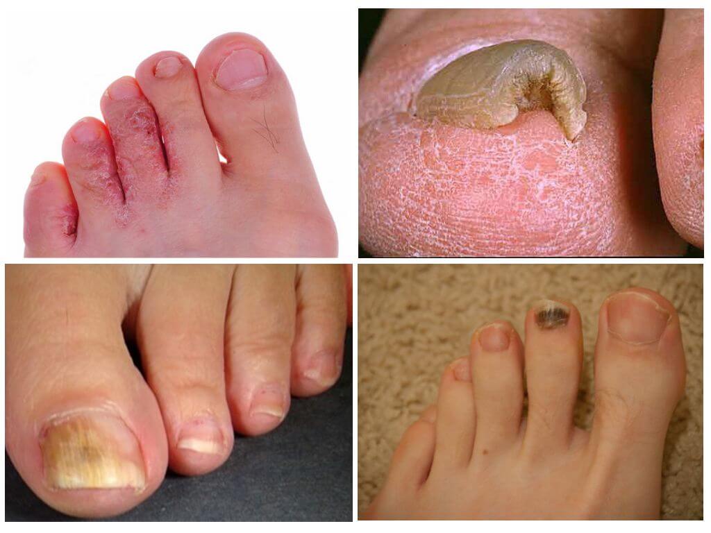 Кандидозное поражение стоп