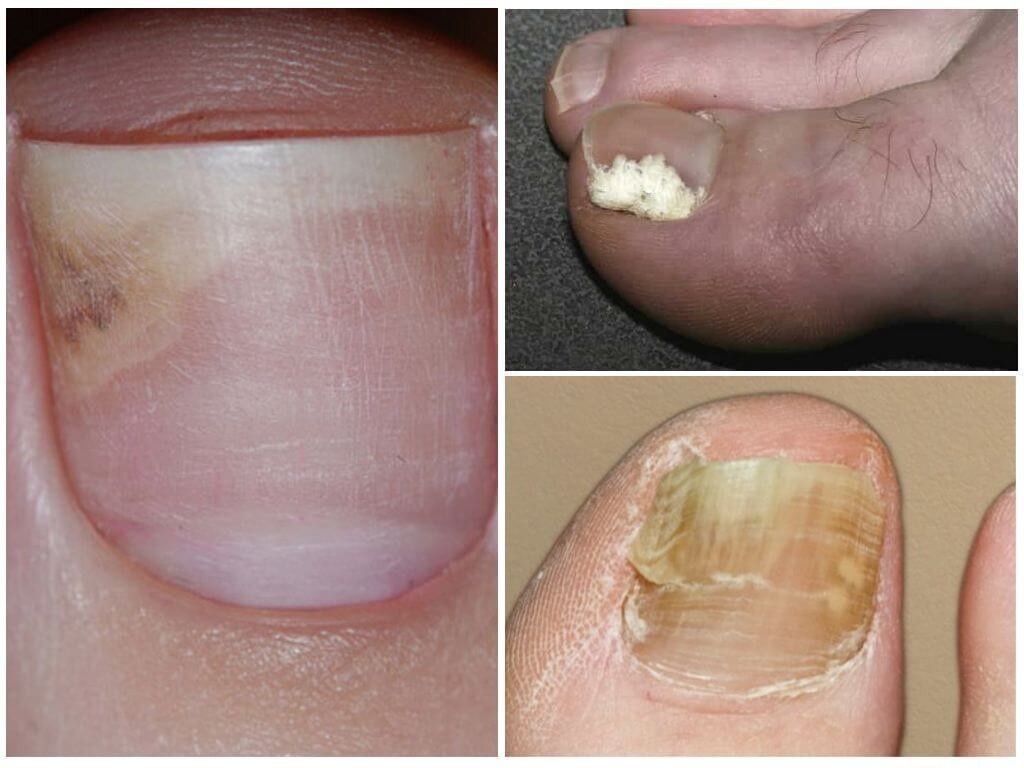 Грибок ногтя на большом пальце ноги