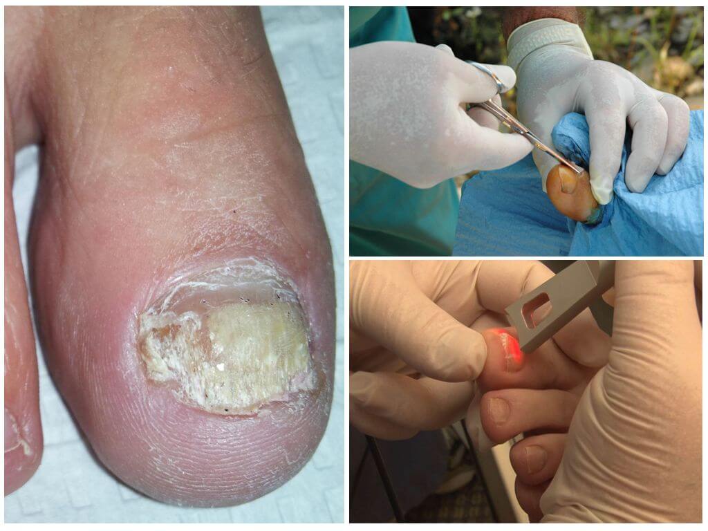 Хирургическое и лазерное лечение грибка