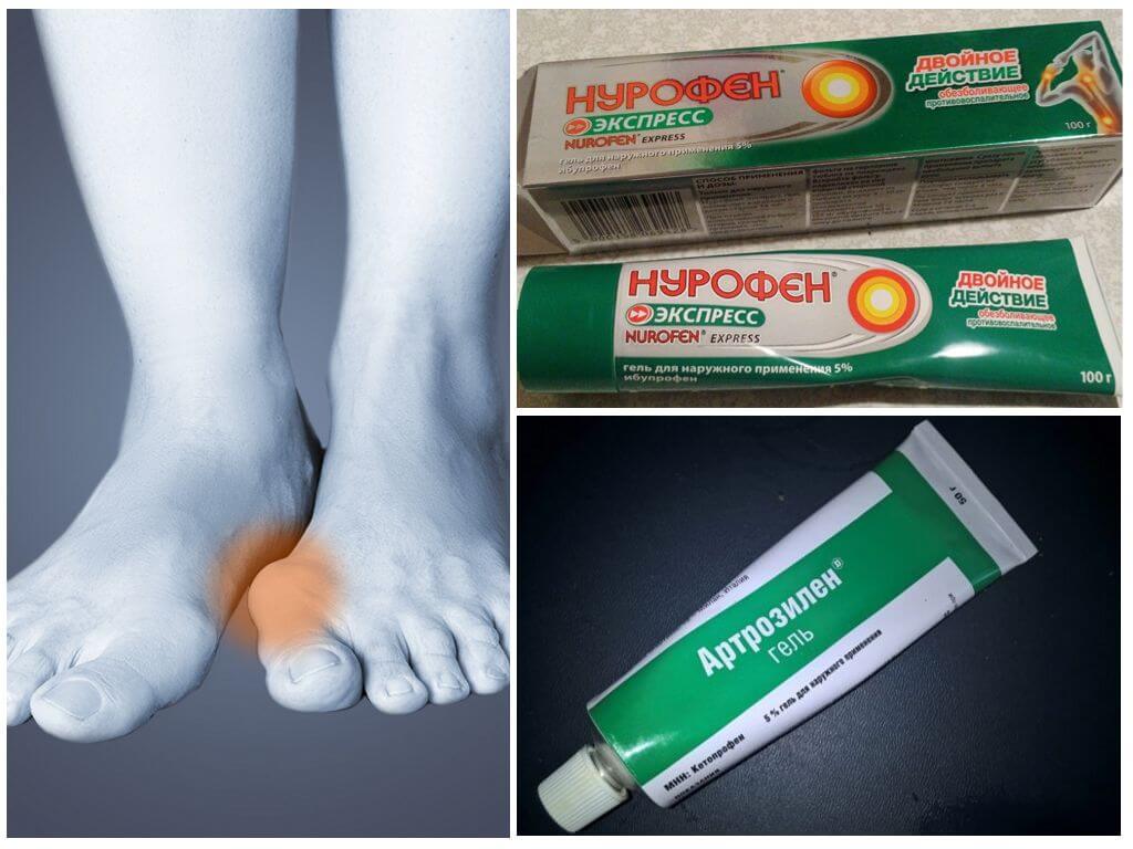 Мази от косточек на ногах