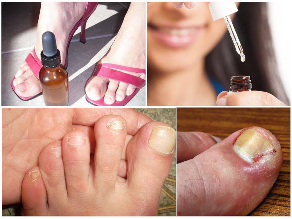 Капли от грибка ногтей на ногах