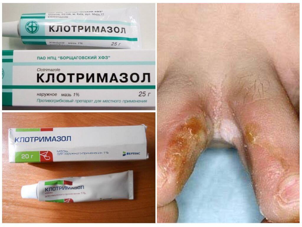 Мазь Клотримазол