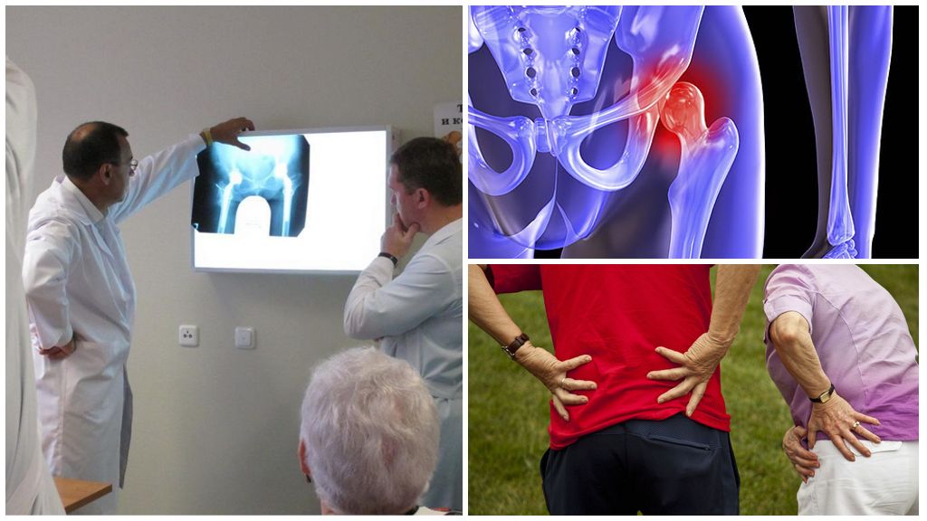 Артроз тазобедренного сустава