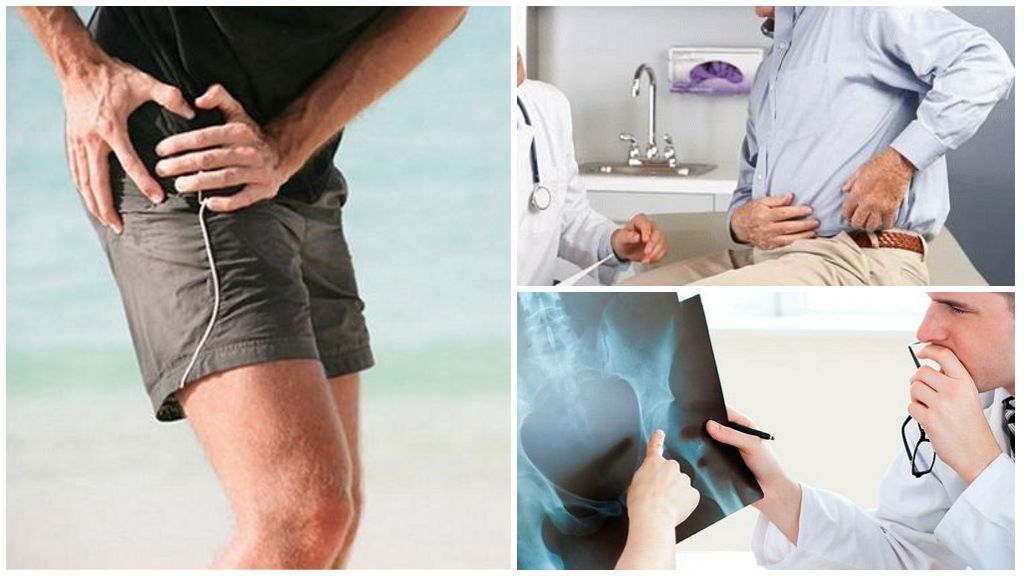 Коксартроз тазобедренного сустава