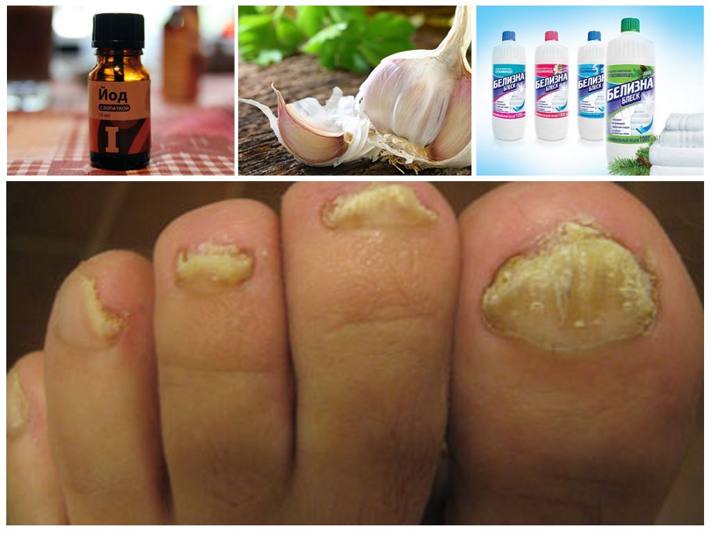 Комплексное лечения грибка белизной