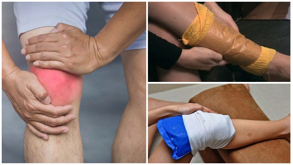 Компрессы при лечении артроза коленных суставов