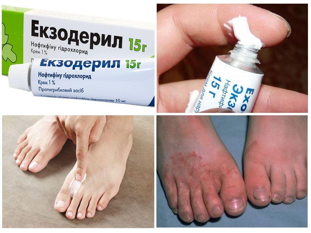 Применение крема Экзодерил