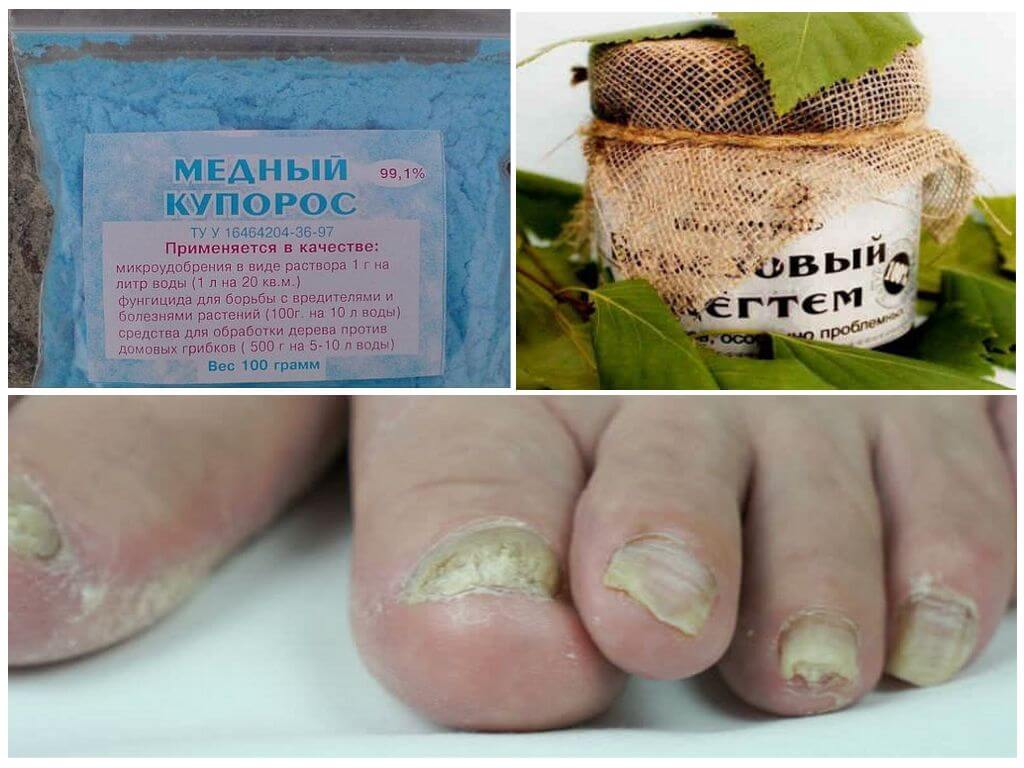 Медный купорос и березовый деготь от онихомикоза