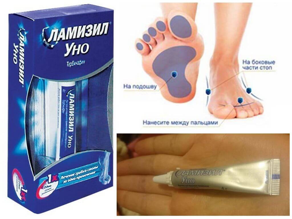 Ламизил Уно от грибка