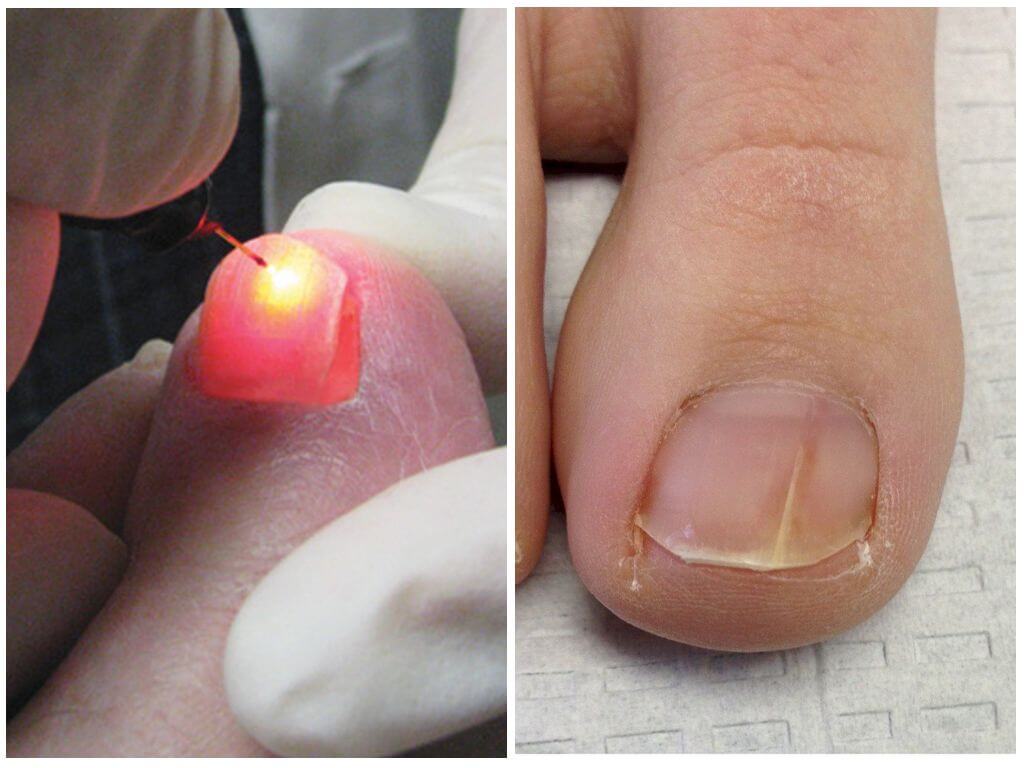 Лазеротерапия