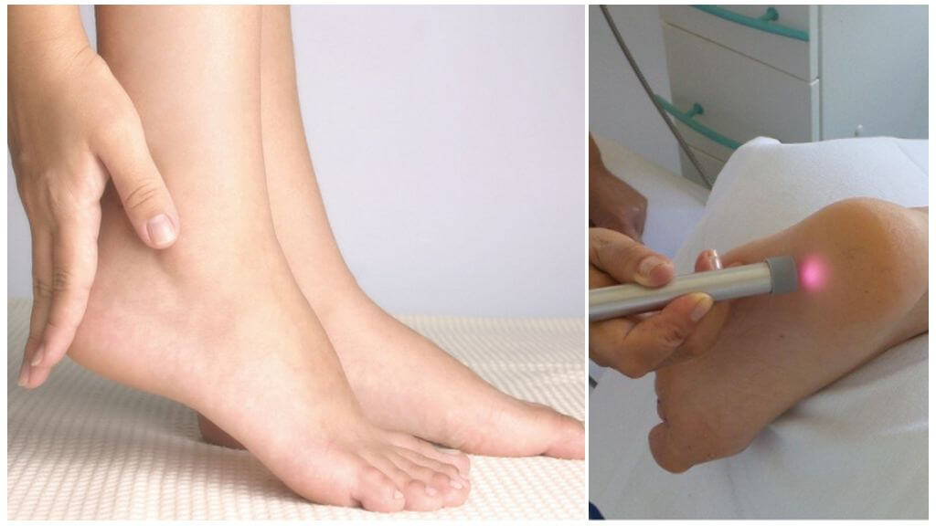 Удаление пяточной шпоры лазером