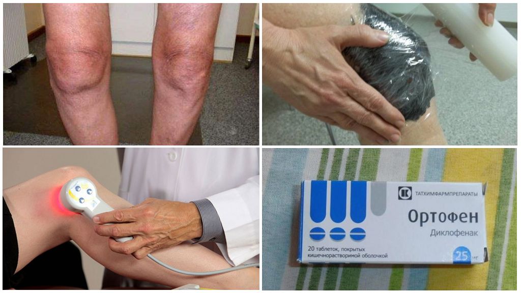 Методы лечения пателлофеморального артроза