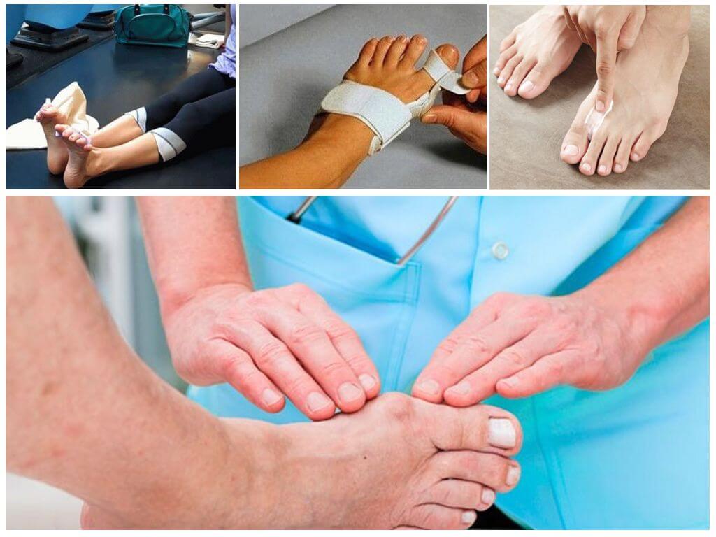 Лечение косточки на большом пальце ноги