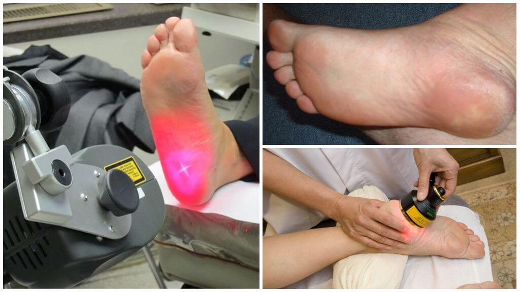 Лечение пяточной шпоры лазером