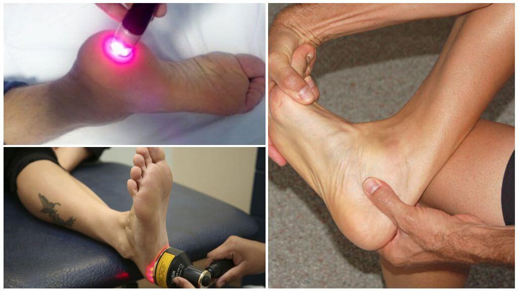 Лечение пяточной шпоры лазером