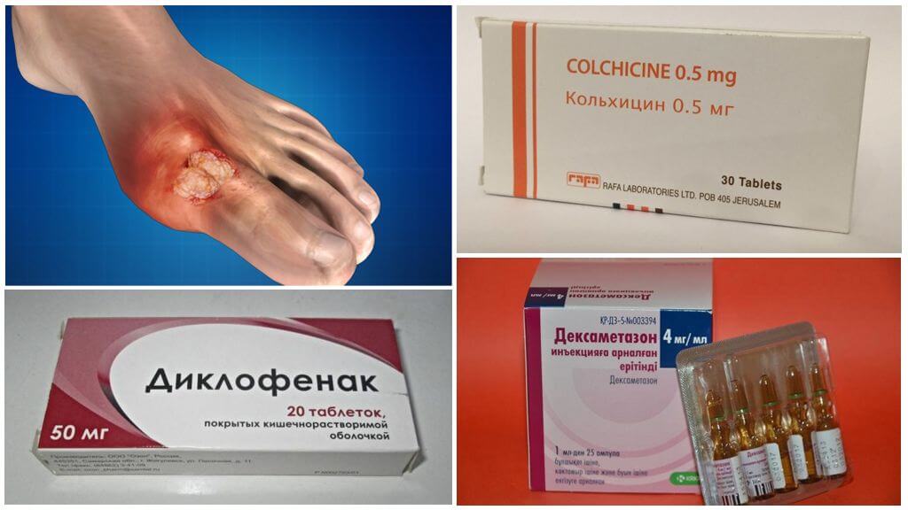 Медикаменты для купирования обострения при подагре