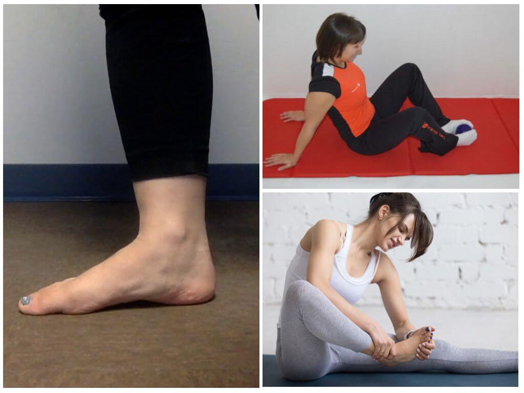 Гимнастика и упражнения от плоскостопия