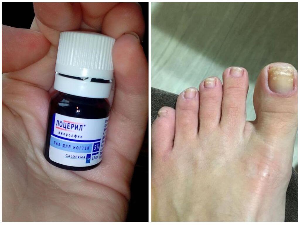 Лак Лоцерил от грибка ногтей